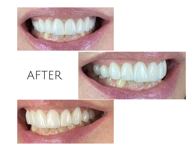 Smile Gallery After Image