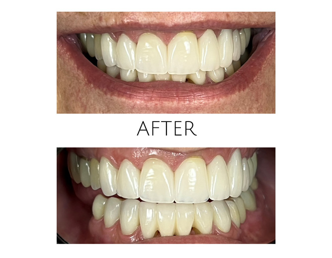 Smile Gallery After Image