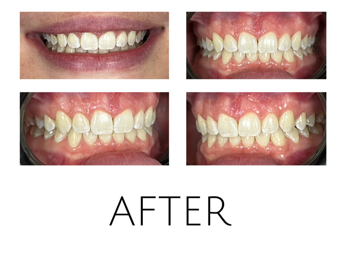 Smile Gallery After Image