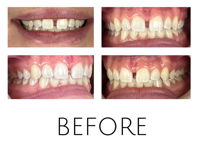 Smile Gallery Before Image