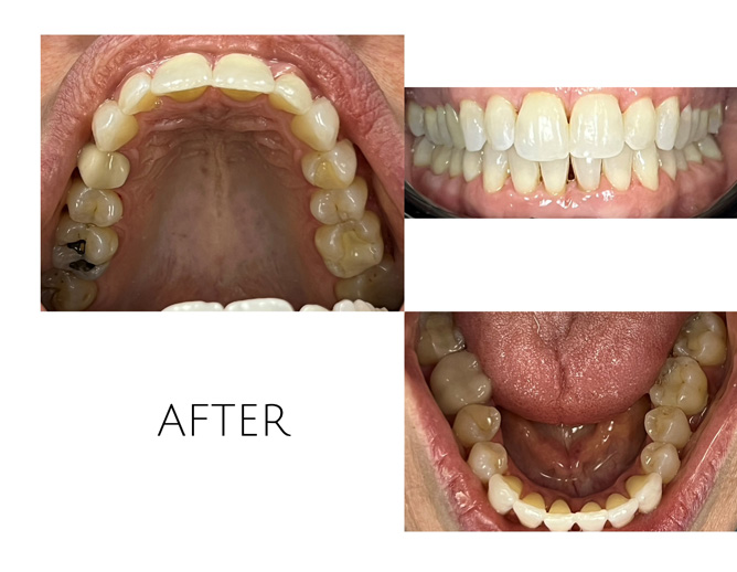 Smile Gallery After Image