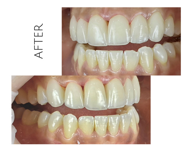 Smile Gallery After Image