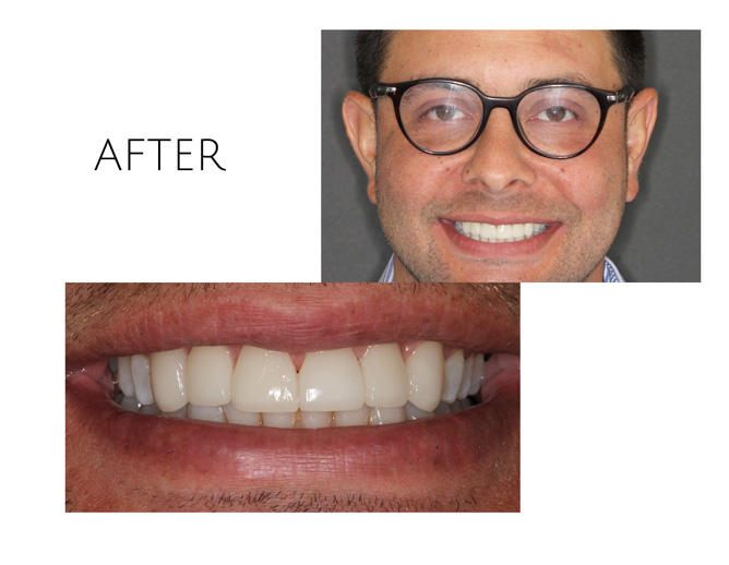 Smile Gallery After Image