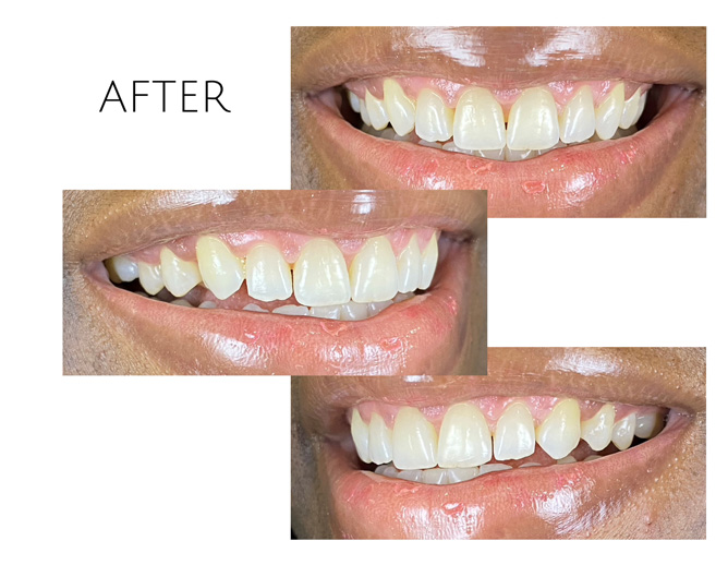 Smile Gallery After Image