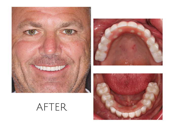 Smile Gallery After Image