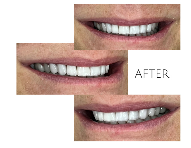 Smile Gallery After Image