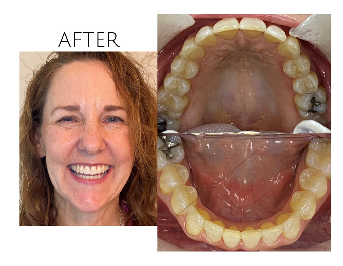 Smile Gallery After Image