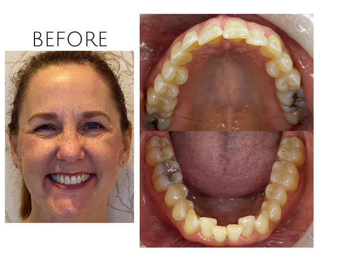 Smile Gallery Before Image