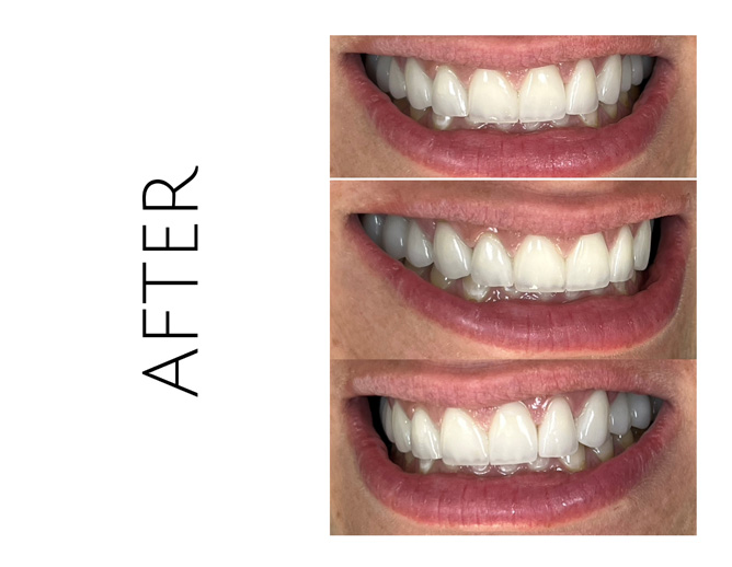 Smile Gallery After Image