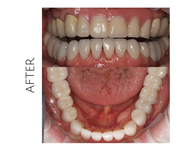 Smile Gallery After Image