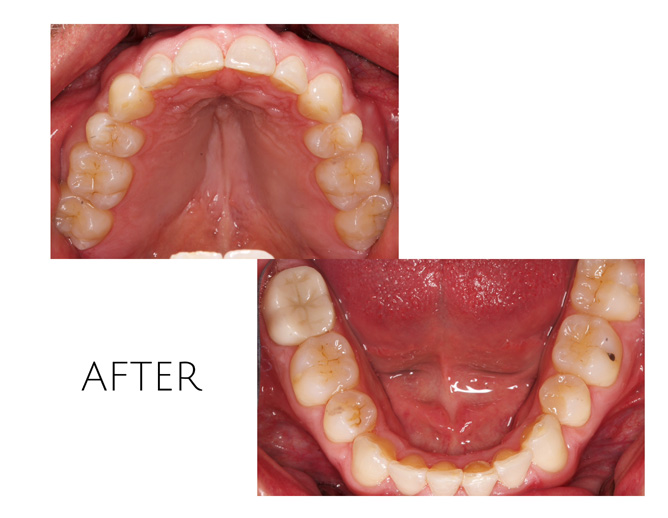 Smile Gallery After Image