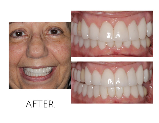 Smile Gallery After Image