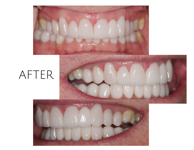 Smile Gallery After Image