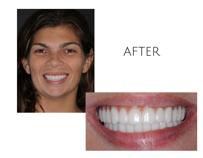 Smile Gallery After Image