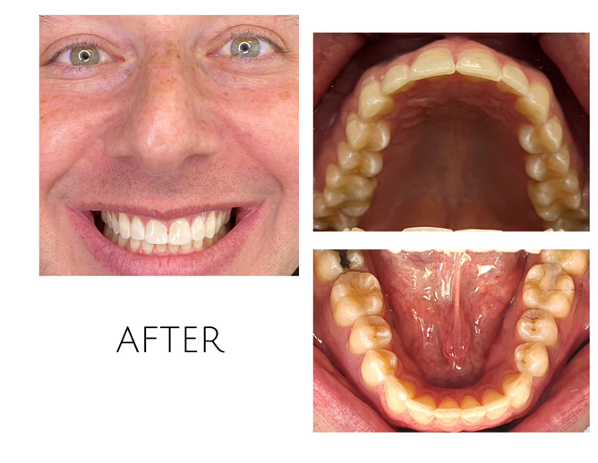 Smile Gallery After Image