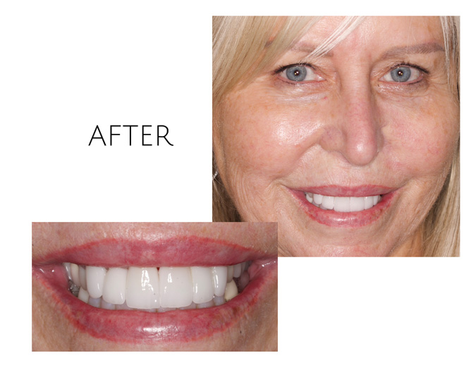 Smile Gallery After Image