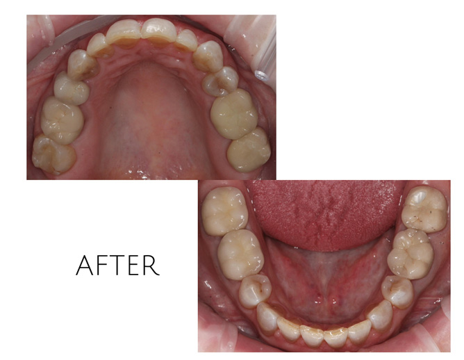 Smile Gallery After Image