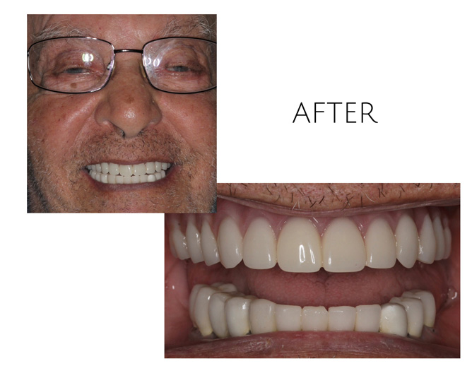 Smile Gallery After Image