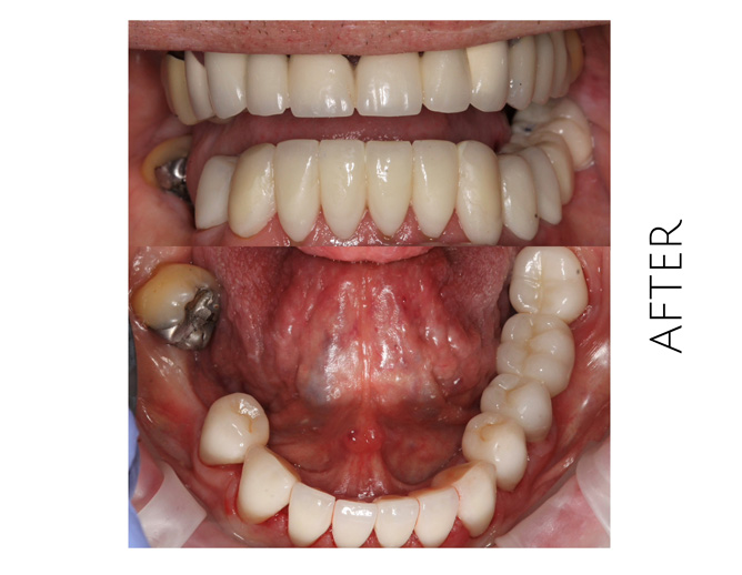 Smile Gallery After Image