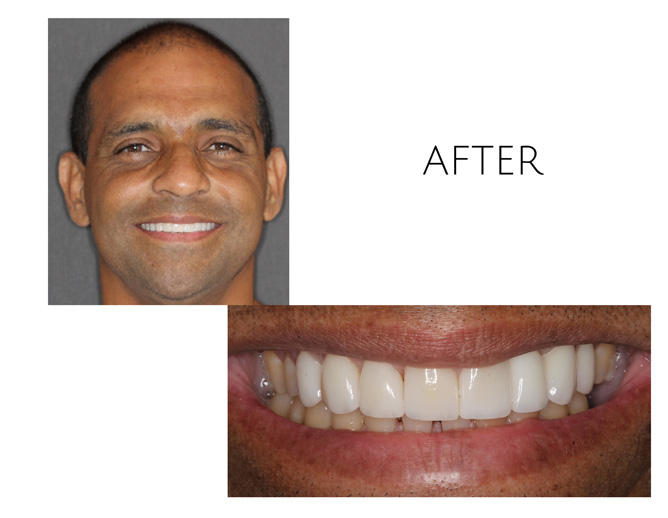 Smile Gallery After Image