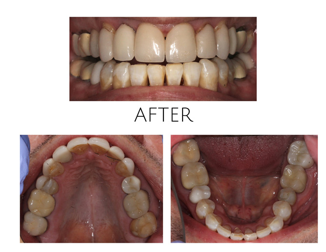 Smile Gallery After Image