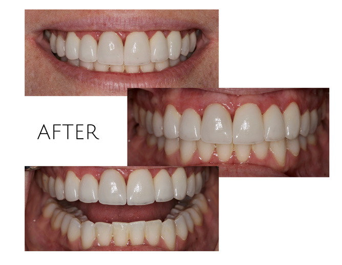 Smile Gallery After Image