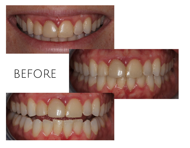 Smile Gallery Before Image