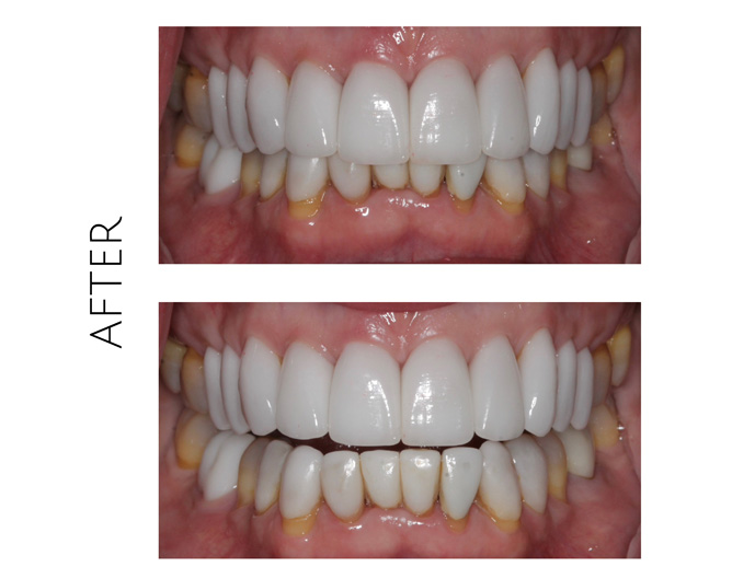 Smile Gallery After Image