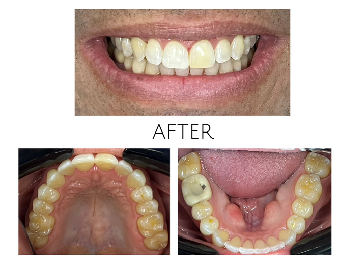 Smile Gallery After Image