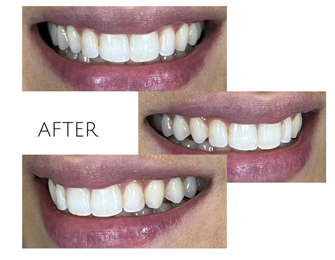 Smile Gallery After Image