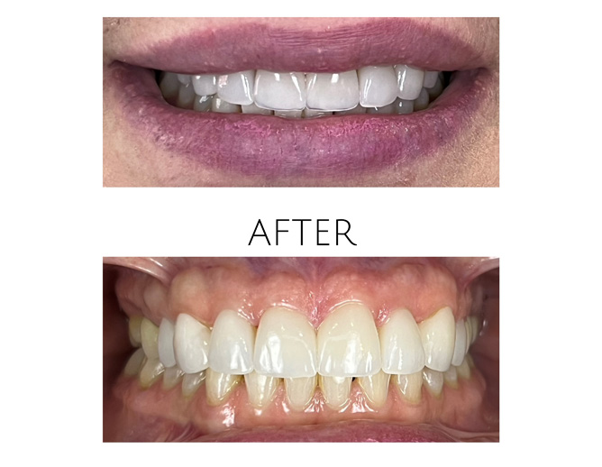 Smile Gallery After Image