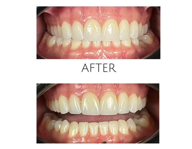 Smile Gallery After Image