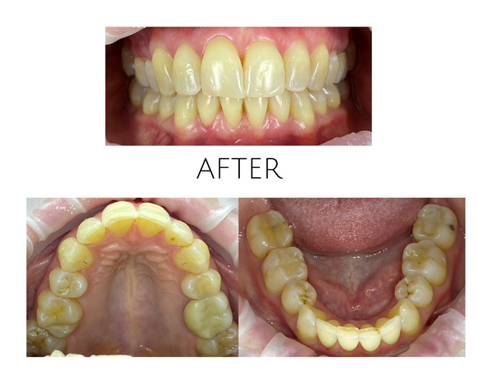 Smile Gallery After Image