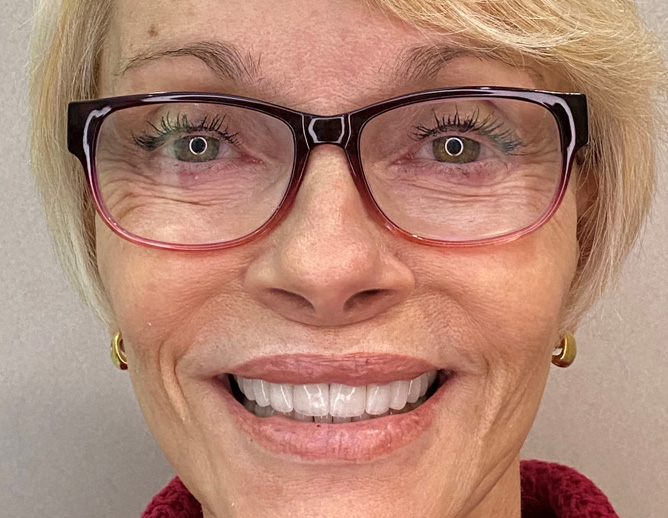 Smile Gallery After Image