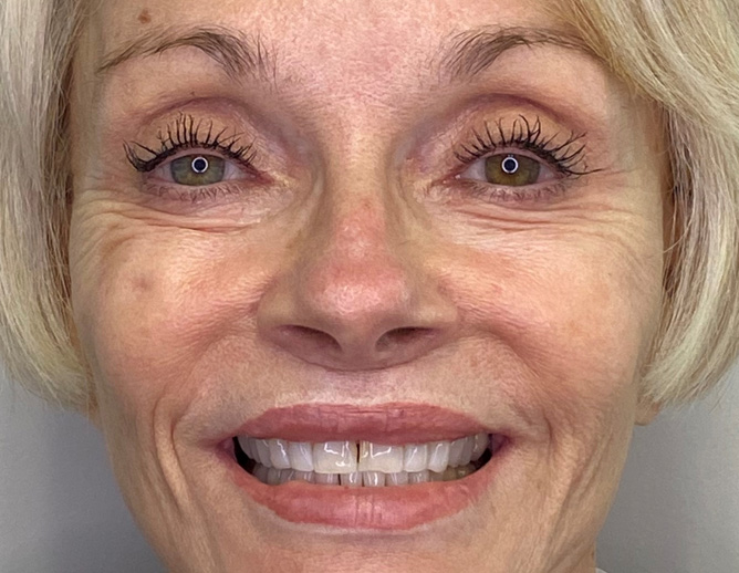 Smile Gallery Before Image