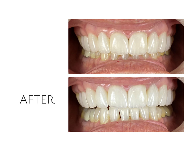 Smile Gallery After Image