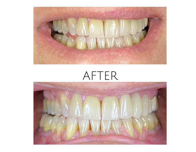 Smile Gallery After Image