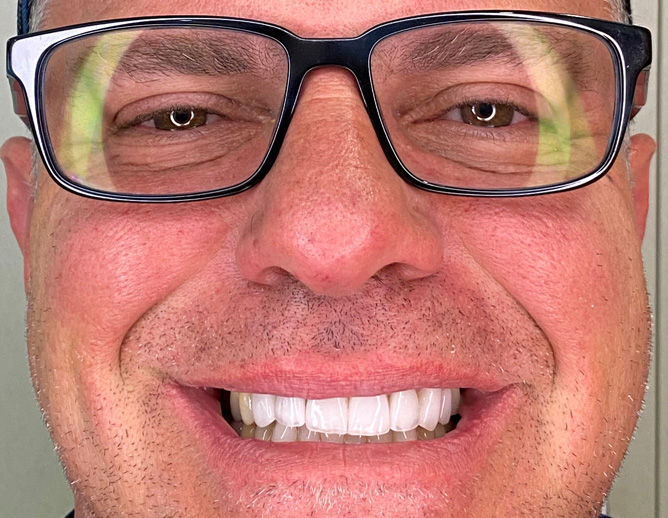 Smile Gallery After Image