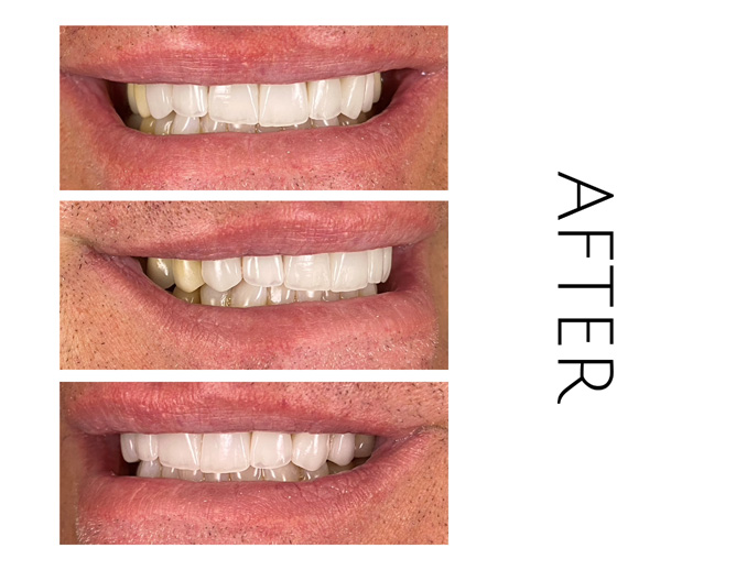 Smile Gallery After Image