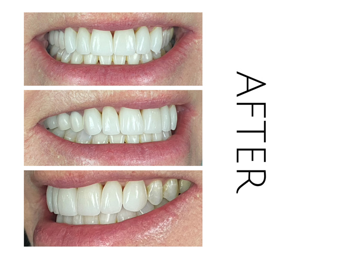 Smile Gallery After Image