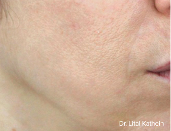 Smile Gallery After Image