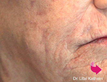 Smile Gallery After Image